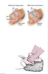 <p>what are some ways to manage obstructive sleep apnea?</p>