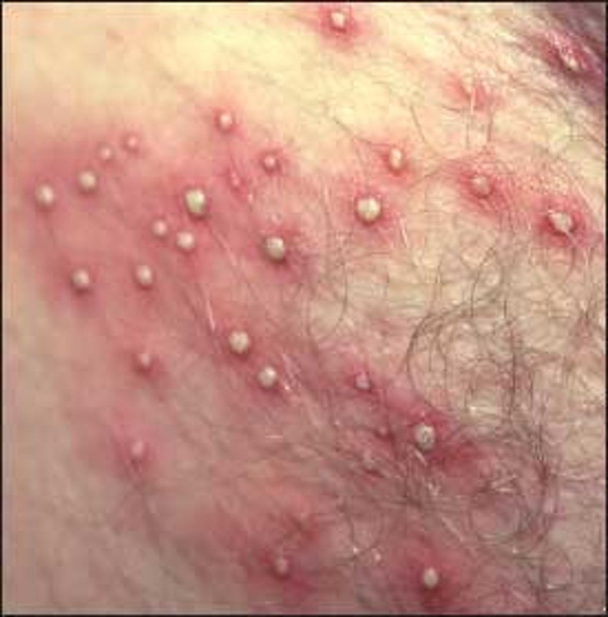 <p>Superficial infection of a hair follicle with small pustules/papules with surrounding erythema</p>