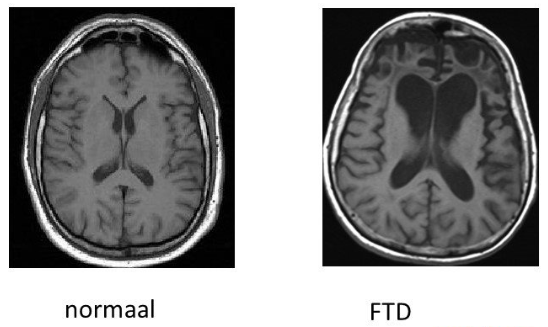 <ul><li><p>frontaal- en temporaalkwab aangedaan</p></li><li><p>ontremd gedrag, ongepast</p></li><li><p>vaak vroeg ontstaan</p></li><li><p>3 varianten (taal-, gedrag-, beweging-)</p></li></ul><p></p><p>Kenmerkend: <br>→ Hyperoraliteit, wat zich kan uiten in veranderingen in dieet of het eten van oneetbare voorwerpen  </p><p></p>