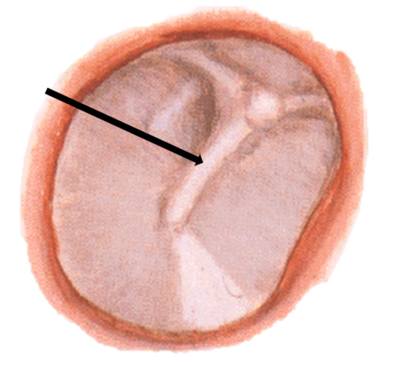 <p>where malleus is attached to fibrous layer of TM</p>
