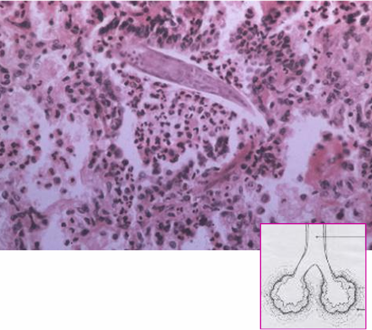 <ul><li><p>grandes reações inflamatórias com formação de exsudados que dificultam a respiração</p></li><li><p>espessamento do tecido pulmonar impedindo as trocas gasosas (epitelização) </p></li><li><p>aparecimento concomitante de infeções bacterianas</p></li></ul><p></p>