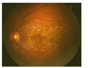 <p>Name the condition</p>