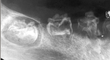 <p>nonhereditary developmental anomaly, most common in max ant teeth, usually involves one quadrant, very large pulps with minimal dentin and enamel </p>