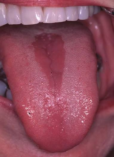 <ul><li><p>Diamond- or oval-shaped denuded area: “bald spot” </p></li><li><p>anterior to circumvallate papillae </p></li><li><p>Denudded</p></li><li><p>Canadidiasis </p></li></ul><p></p>