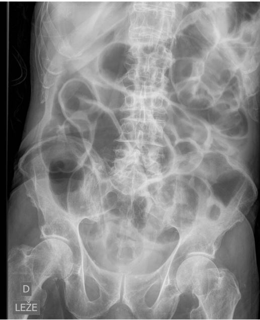 <p>82 l, M, Mb. Crohn, st. po totalni kolektomiji pred 48h, mizerere</p><p></p><ol><li><p>Imenuj tehniki slikanja </p></li><li><p>Kateri organ je prikazan? </p></li><li><p>Diagnoza? </p></li><li><p>Vzrok ileusa?</p></li></ol><p></p>