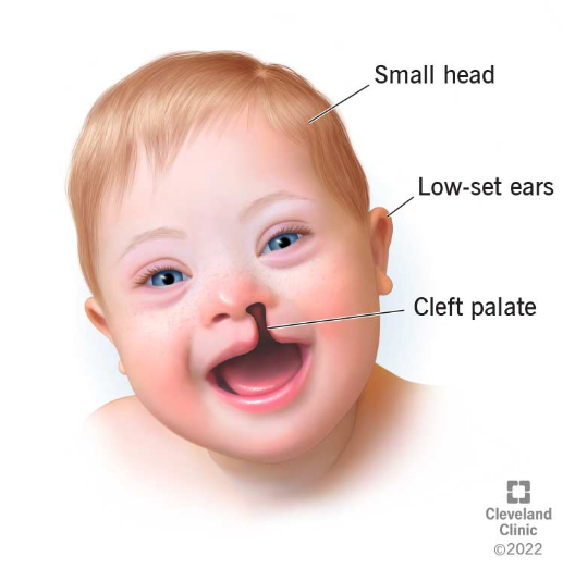 <p><strong>Extra </strong>copy of <strong>chromosome 13</strong>; <strong>Severe developmental and physical abnormalities</strong>, including intellectual disabilities, heart defects, and <strong>cleft lip and palate</strong></p>