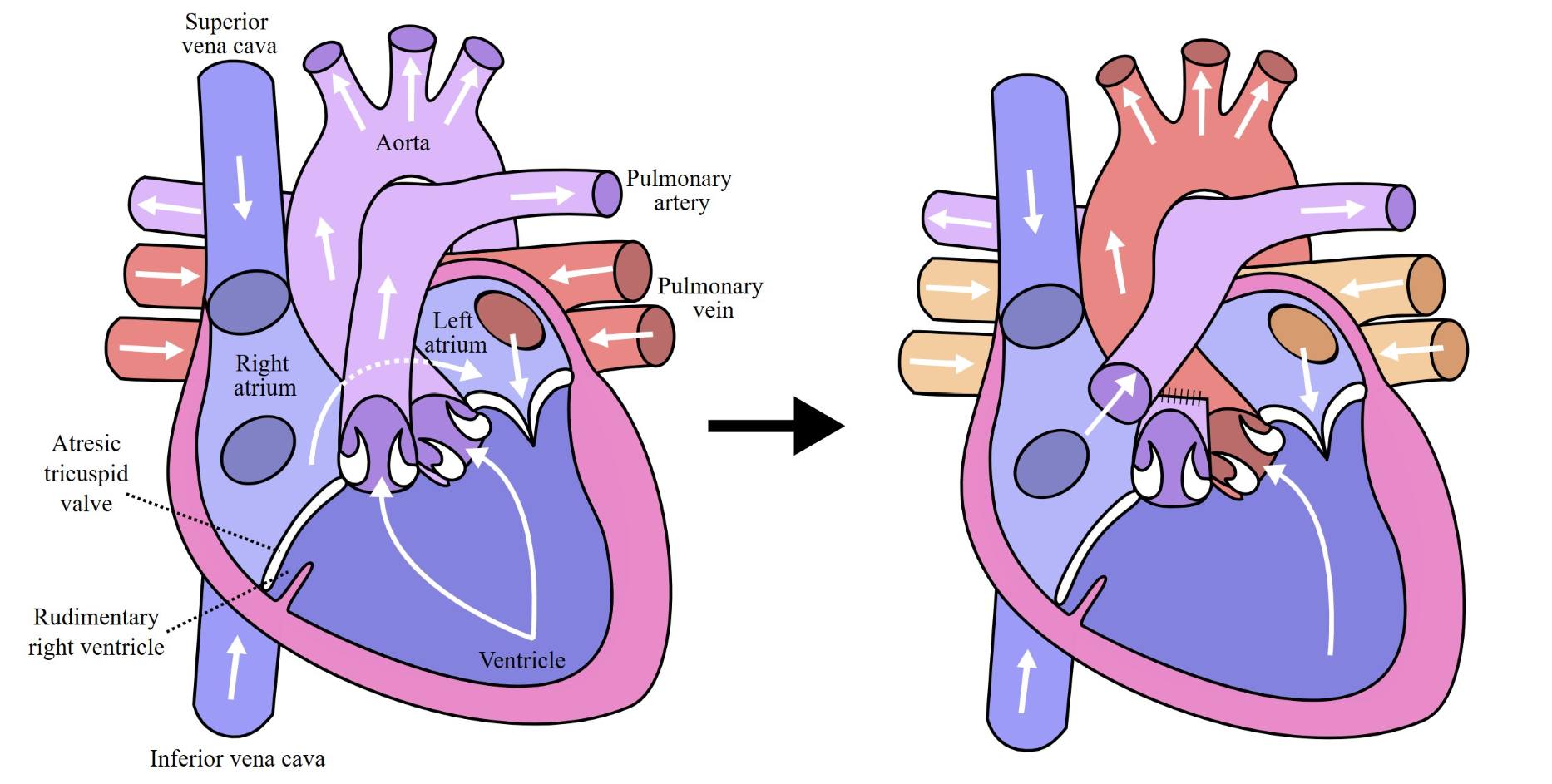 <ul><li><p>The fontan circulation consists of a hypoplastic right heart or tricuspid atresia where there is a single ventricle</p></li></ul><ul><li><p>As a result these children have a palliative procedure performed whereby their single ventricle pumps blood to the systemic circulation but the pulmonary circulation is driven by purely passive flow of blood returning via SVC/IVC into the right heart and flowing into the pulmonary artery (without any pressure established from an RV)</p></li></ul><p></p><ul><li><p>The implications of this are that:</p><ul><li><p>They are very preload dependent and loss of preload results in loss of pulmonary circulation and CO</p></li><li><p>They respond poorly to changes in Pa02 / PaC02 upon their pulmonary circulation</p></li><li><p>PEEP and IPPV are tolerated relatively poorly on the pulmonary circulation</p></li><li><p>They are at risk of VTE and are generally anti-coagulated</p></li></ul></li></ul><p></p>