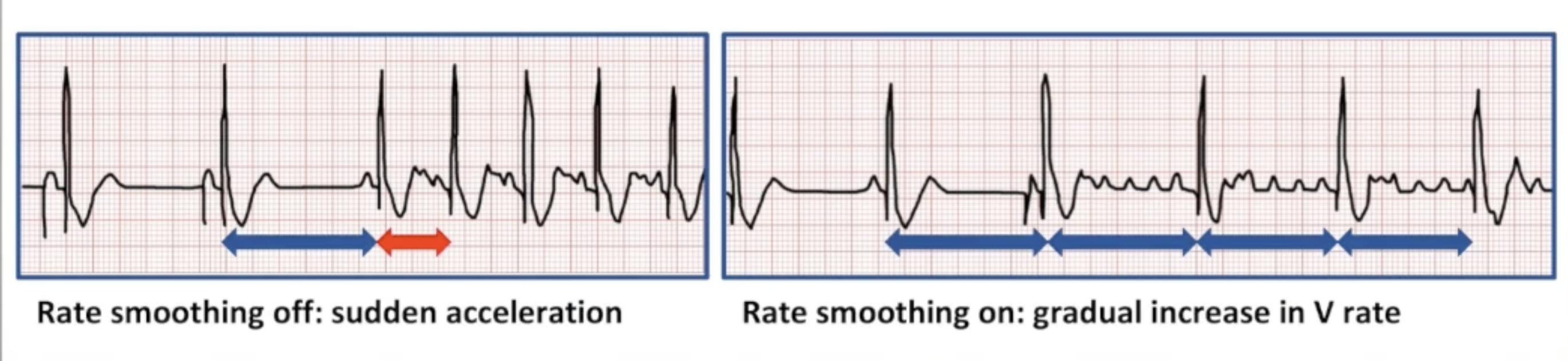 <ul><li><p>Reduces symptoms from rate changes</p></li><li><p>Beat-to-beat basis: maximum percentage change in interval</p></li><li><p>AT/AF starts: gradually increases ventricular rate</p></li><li><p>AT/AF stops: gradually decreases ventricular rate</p></li><li><p>Many mode switch algorithms have rate smoothing built in</p></li></ul><p></p>