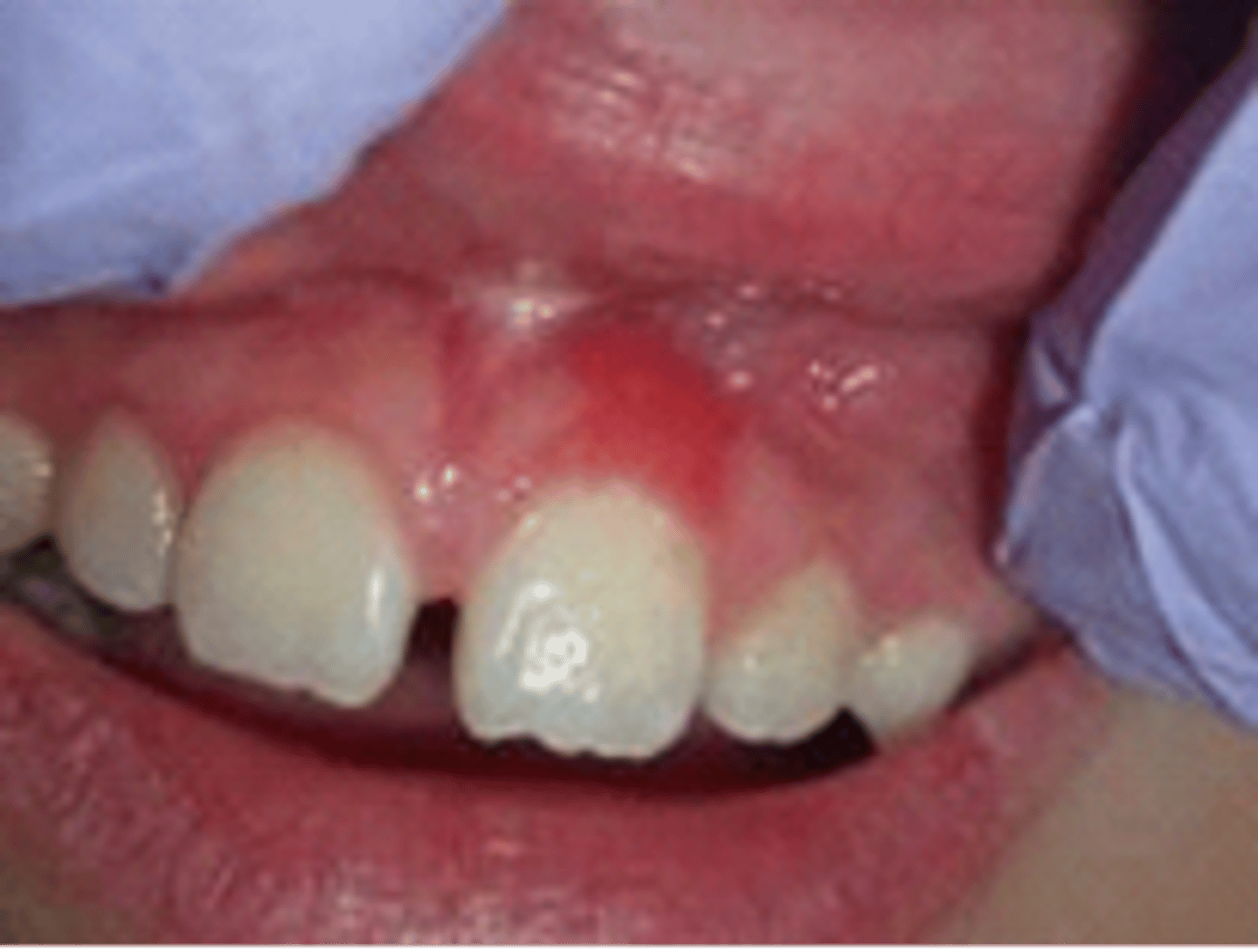 <p><br></p><p>Distinct subtype of gingivitis that does not respond to local plaque control. Appears as papillary or velvety, red nodule that bleeds easily</p><p><br></p><p>This flat, red, velvety lesion involving the maxillary anterior gingiva in an 8-year-old male resolved entirely after topical corticosteroid therapy. What is your DHDx?</p>