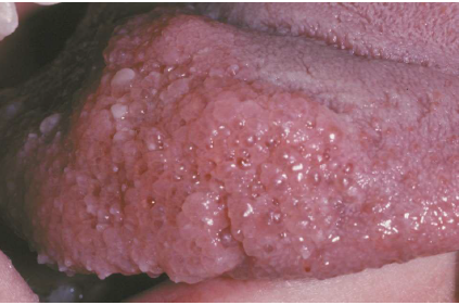 <ul><li><p>benign lymphatic counterparts of hemangiomas</p><ul><li><p>simple capillary lymphangiomas</p></li><li><p>cavernous lymphangiomas (cystic hygromas)</p></li></ul></li><li><p>oral lesions: tongue is the most common sites with a “frogs egg” appearance</p></li><li><p>deeper tumors appear as ill-defined masses</p></li><li><p>alveolar lymphangiomas </p></li></ul><p></p>