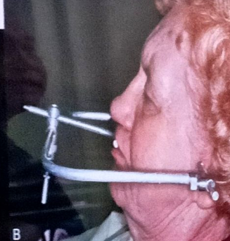 <p>this facebow takes it name from the fact that it rests upon the face like the kinematic bow</p>