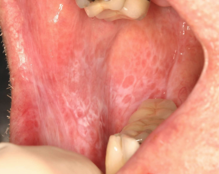 <p>lichen planus (reticular)</p>