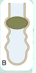 <p>Define <strong>Acquired Obstructive Atelectasis</strong> based on its mechanical mechanism and its primary physiological consequence:</p>