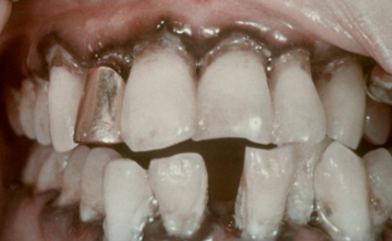 <p>from lead poisoning (plumbism) </p>