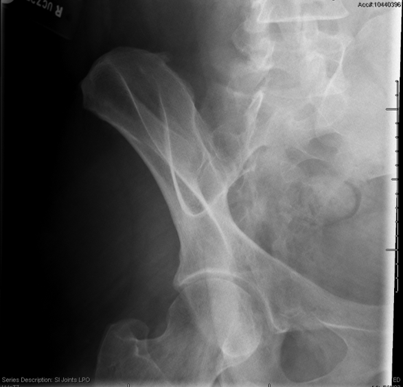 <p>critique this Oblique SI joints</p>
