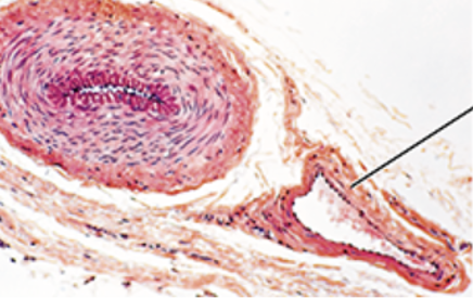 <p>How do you know this is a(n) vein? </p>