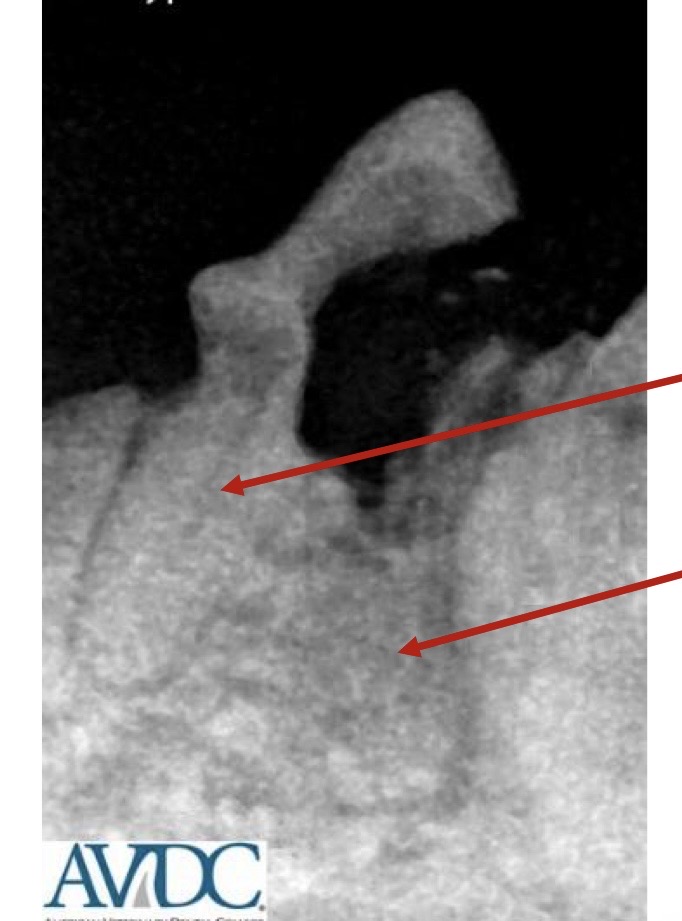 <p>what type of tooth resorption is this?</p>