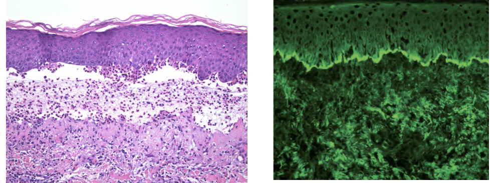 <p>1) diagnostic </p><p>2) histologie</p><p>3) IFD</p>