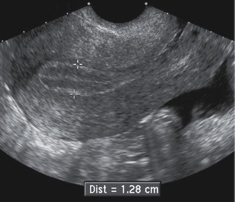 <p> three-line sign-the outer echogenic basal layer surrounds the more hypoechoic functional layer, with the functional layer separated by the echogenic endometrial stripe</p>