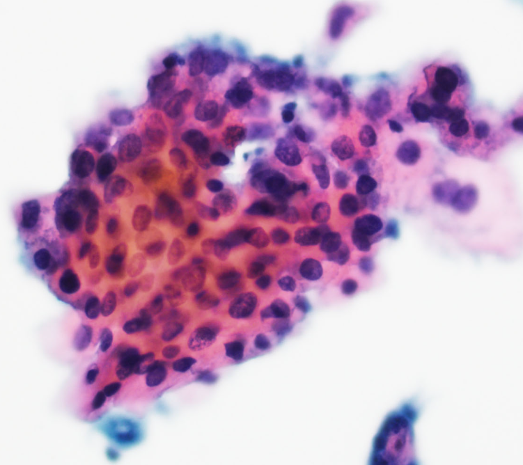 <p>Pap smear: Which HPV subtype is most likely associated with this lesion</p>