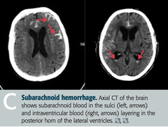 <p>ruptured blood vessel</p>