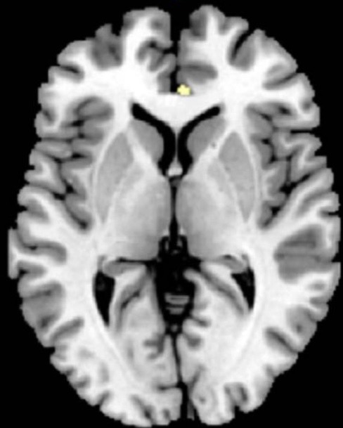 <p>Platek and Singh 2010</p><p>Changes in waist hip ratio activated anterior paracingulate gyrus of men </p>