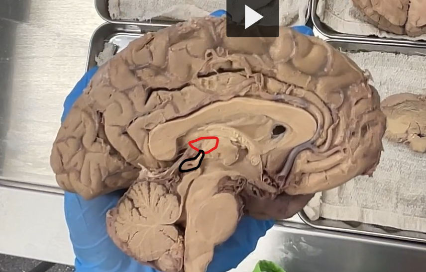 <p>red: epithalamus (posterior to the thalamus)</p><p>black: pineal gland (projection from the epithalamus)</p><p><strong>Epithalamus — Etymology &amp; Definition</strong> </p><p><strong>Etymology</strong> </p><ul><li><p><strong>Greek roots:</strong></p><ul><li><p><strong><em>epi-</em></strong> = “upon” or “above”</p></li><li><p><strong><em>thalamos</em></strong> = “inner chamber” (→ thalamus)</p></li></ul></li></ul><p> So, <strong><em>epithalamus</em> literally means “upon/above the thalamus.”</strong></p><p>  <strong>Definition (Neuroanatomy)</strong> </p><ul><li><p>The <strong>epithalamus</strong> is:</p><ul><li><p>The <strong>posterior–superior part of the diencephalon</strong></p></li><li><p>Located <strong>above and behind the thalamus</strong></p></li><li><p>Forms part of the <strong>roof of the third ventricle</strong></p></li></ul></li></ul><p><strong>Key Structures (High-Yield)</strong> </p><ul><li><p><strong>pineal gland</strong></p></li><li><p><strong>Habenular nuclei</strong> (emotion/reward pathways)</p></li><li><p><strong>posterior commissure</strong></p></li></ul><p><strong>Functions</strong> </p><ul><li><p><strong>Pineal gland:</strong></p><ul><li><p>Secretes <strong>melatonin</strong></p></li><li><p>Regulates <strong>circadian rhythms (sleep–wake cycle)</strong></p></li></ul></li><li><p><strong>Habenular nuclei:</strong></p><ul><li><p>Involved in <strong>emotional processing</strong>, reward, and aversion</p></li></ul></li><li><p><strong>Posterior commissure:</strong></p><ul><li><p>Coordinates <strong>bilateral eye reflexes</strong> (especially pupillary light reflex)</p></li></ul></li></ul><p><strong>Pineal Gland — Etymology &amp; Definition</strong> </p><p> <strong>Etymology</strong> </p><ul><li><p>From Latin <strong><em>pinea</em></strong> = “pine cone” </p></li></ul><ul><li><p><strong><em>gland</em></strong> = a secreting organ</p></li></ul><p>So, <strong><em>pineal gland</em> literally means “pine cone–shaped gland.”</strong></p><p> <strong>Definition (Neuroanatomy)</strong> </p><ul><li><p>The <strong>pineal gland</strong> is:</p><ul><li><p>A <strong>small endocrine gland</strong></p></li><li><p>Located in the <strong>epithalamus</strong></p></li><li><p>Positioned <strong>posterior to the third ventricle</strong>, between the two thalami</p></li></ul></li></ul><p><strong>Function (High-Yield)</strong> </p><p>Regulates circadian rhythms via melatonin</p><ul><li><p>Secretes <strong>melatonin </strong>(not melanin)</p></li><li><p>Controls:</p><ul><li><p><strong>Sleep–wake cycle</strong></p></li><li><p><strong>Biological clock</strong></p></li></ul></li><li><p>Light exposure ↓ melatonin</p></li><li><p>Darkness ↑ melatonin</p></li></ul><p></p>