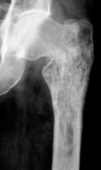 <p>What type of bone destruction is this?</p>