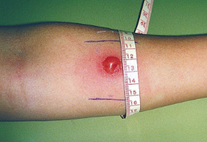 <p>Tuberculosis is diagnosed through the <strong>Tuberculin skin test</strong></p><ul><li><p><strong>Purified protein </strong>from the <strong>bacteria </strong>is <strong>injected </strong>into the <strong>skin</strong></p></li><li><p>If the person has Tuberculosis, <strong>T</strong> and<strong> B cells </strong>will <strong>react </strong>with the <strong>protein</strong>, leading to the <strong>hardening </strong>and <strong>reddening</strong> of <strong>injection site</strong></p></li></ul><p></p>
