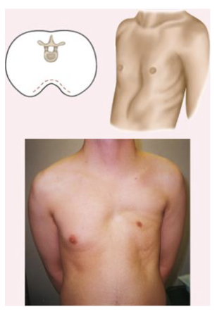 <p>inverted sternum</p>