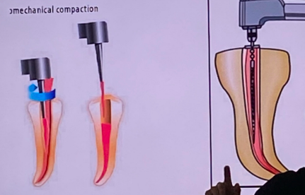 <p>uses a <span style="color: red;">rotating compactor</span> (ex: <span style="color: red;">McSpadden Compactor)</span> to <span style="color: red;">generate frictional heat</span>, <span style="color: red;">softening</span> and compacting gutta-percha</p>