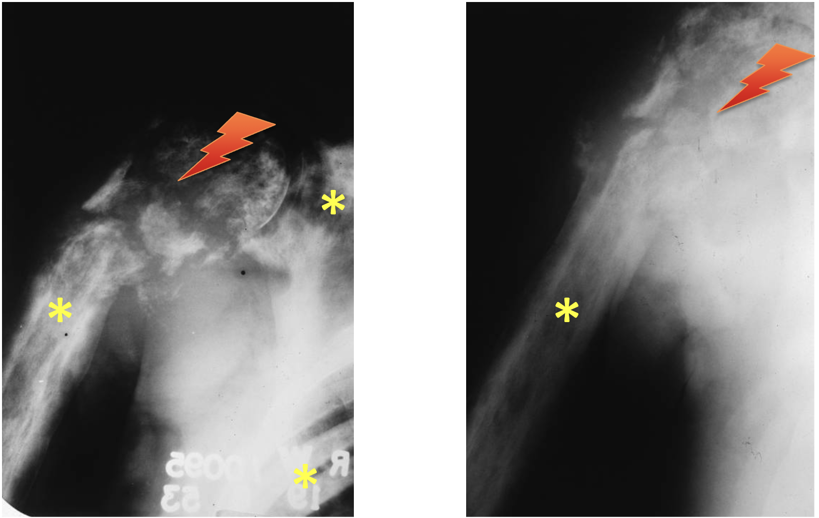 <p>What tumour like disorder is this?</p>