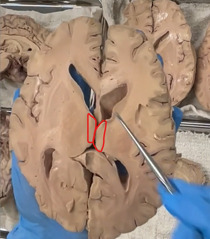 <p>medial to the globus pallidus is the thalamus.</p>