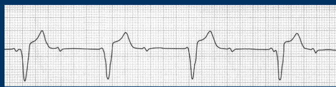 <p>In this rhythm the P wave looks weird, there is not always a P wave before QRS. The QRS is not measurable and is (WIDE) bc impulse came from ventricles. </p>