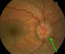 <ul><li><p>Bilateral swelling due to increased intracranial pressure</p></li><li><p>Risk: Obese, young females</p></li><li><p>Headaches</p></li><li><p>Untreated → Optic atrophy</p></li></ul><p></p>