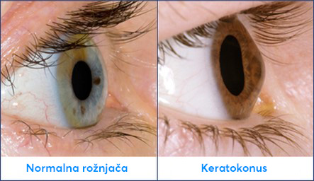<p>= <strong>tanjšanje </strong>ene ali obeh roženic v centralnem predelu, vedno bolj je <strong>stožčasto izbočena</strong>, vidna sposobnost vedno manjša</p><ul><li><p>genetika, po puberteti: blaga motnja vida, naraščujoč astigmatizem </p></li><li><p>redčenje, konusna oblika</p></li><li><p>nastane obroč zaradi odlaganja železa v epiteliju</p></li><li><p>prekatna vodica lahko vre v stromo (membrama poči)</p></li></ul><p></p><p>(astagmatizem = nepraviljena ukrivljenost roženice, svetloba se ne fokusira na 1 točko na mrežnici)</p><p></p>