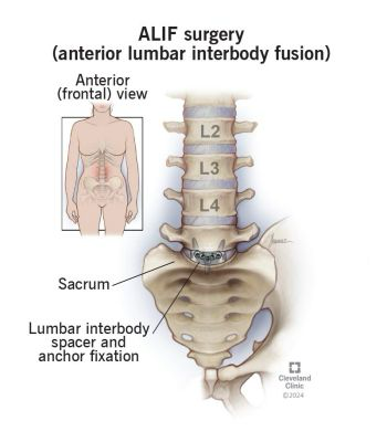 <p>Facets / Vertebral bodies are fused from the back</p>