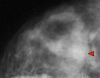 <ul><li><p>Likely malignant </p></li><li><p>Poorly defined spiculated mass </p></li><li><p>Dense </p></li></ul><p></p>