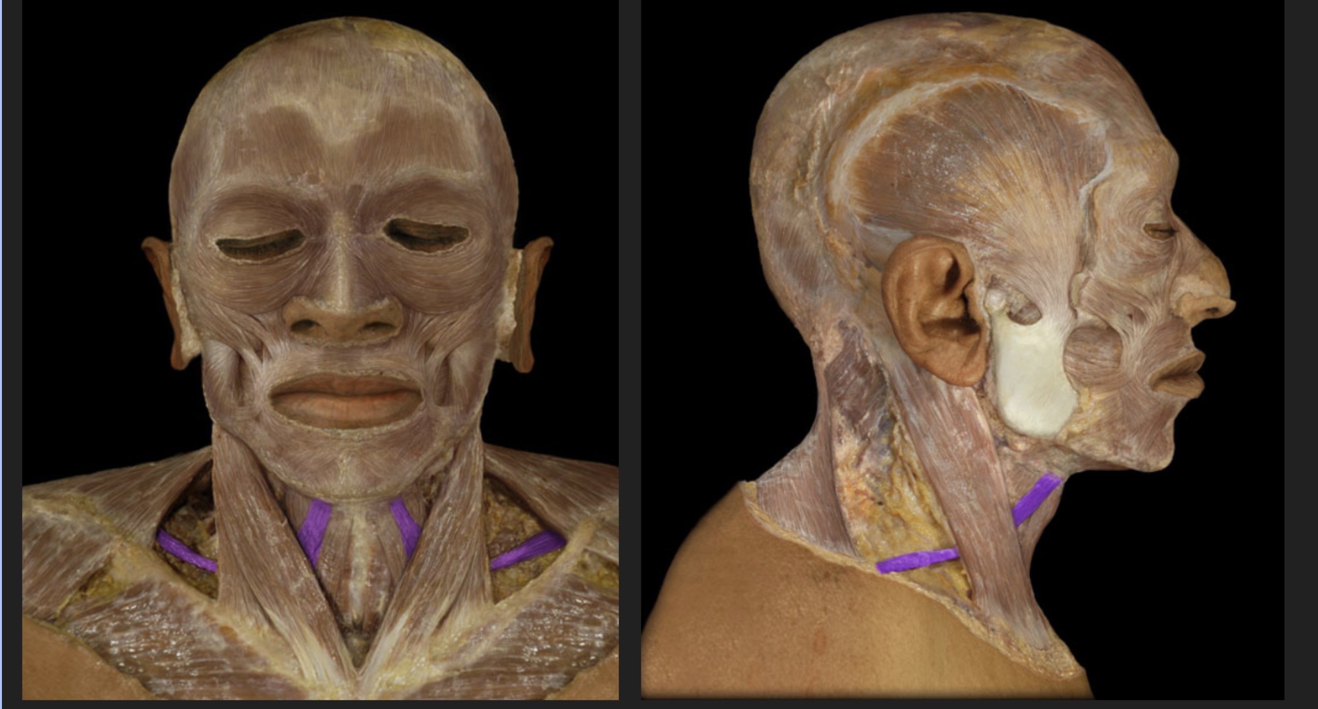 <p>Strap muscle that helps depress the hyoid bone</p>