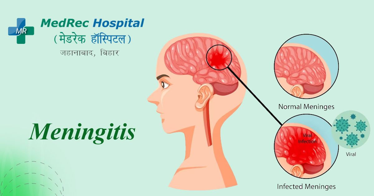 <p>An <strong>inflammation of the membranes (meninges) surrounding the brain and spinal cord</strong>, usually caused by an <strong>infection</strong>.</p>