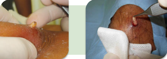 <p>Infección cutánea producida por larvas de dípteros (moscas) que depositan sus huevos o larvas en la piel. Se presenta como una lesión nodular eritematosa y dolorosa semejante a un forúnculo con un orificio central.</p>