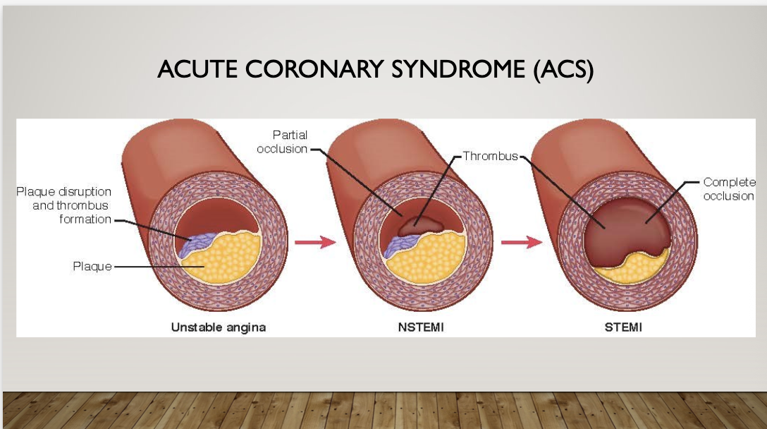 <p>acute coronary syndrome</p>