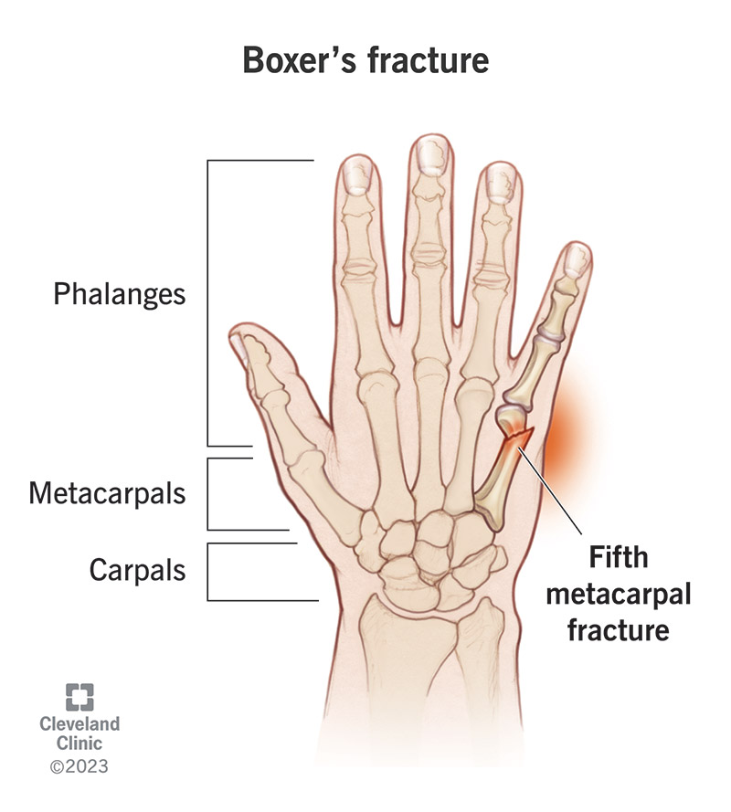 <p>Fracture of the neck of the 5th metacarpal. </p><ul><li><p>caused by punching with closed fist</p></li></ul><p></p>