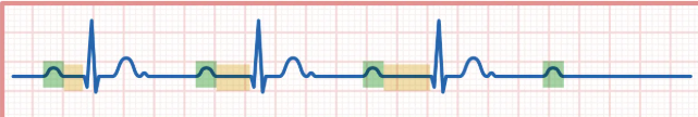 <p>PR intervals gradually lengthen, until P waves don’t conduct to QRS</p>