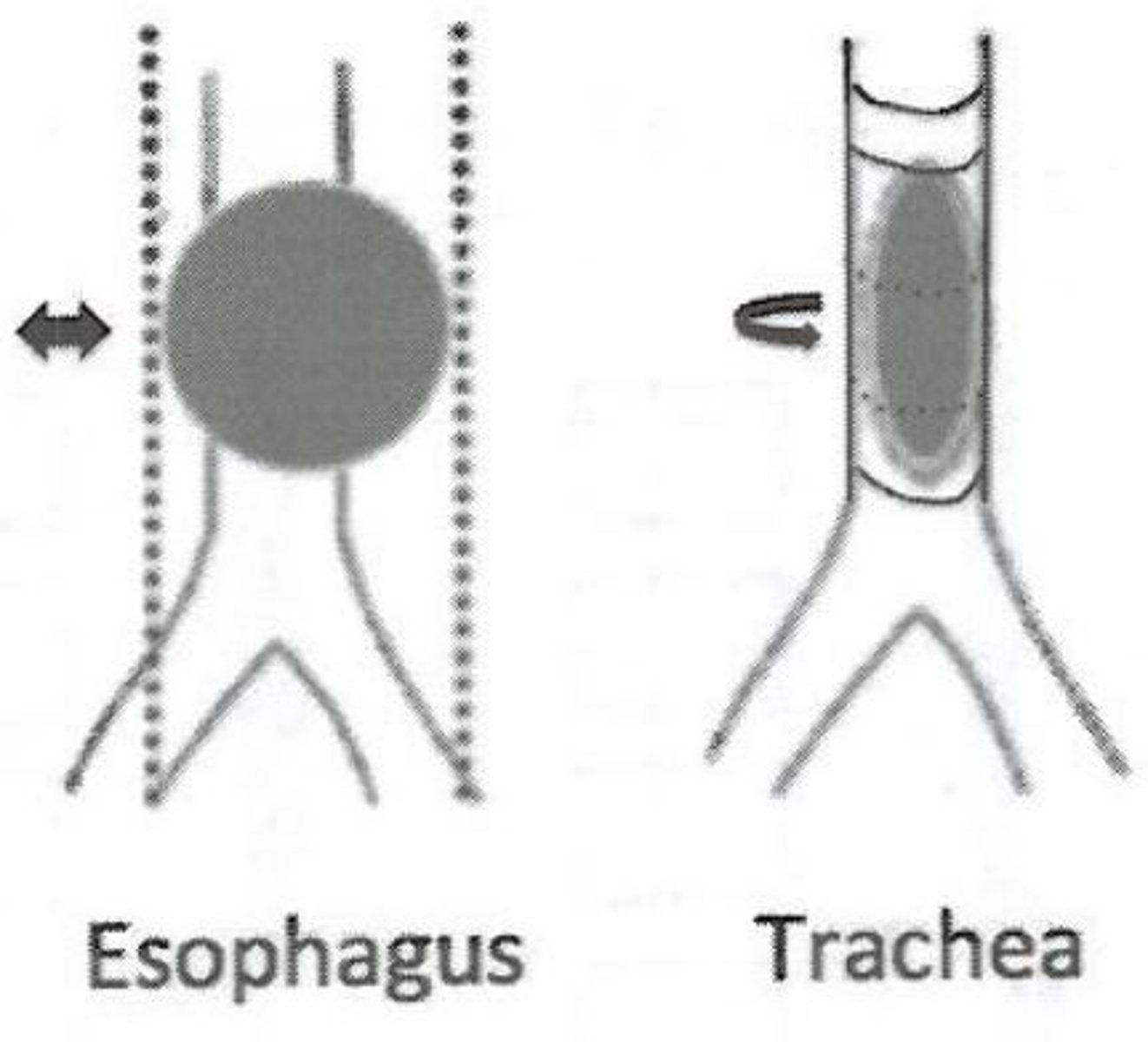 <p>-mechanical obstruction, usually when foreign objects are swallowed into bronchial tree</p><p>-AP + Lateral Chest, AP + Lateral upper airway X-Rays</p>