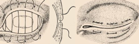 <p>- Use #0 and #1 non-absorbable suture in a horizontal mattress pattern</p>