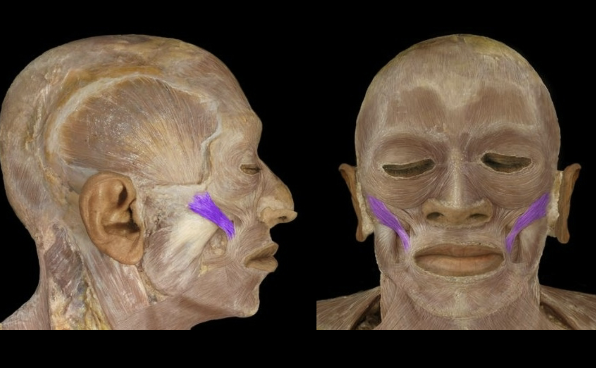 <p>Extends from the corner of the mouth to the cheek</p>