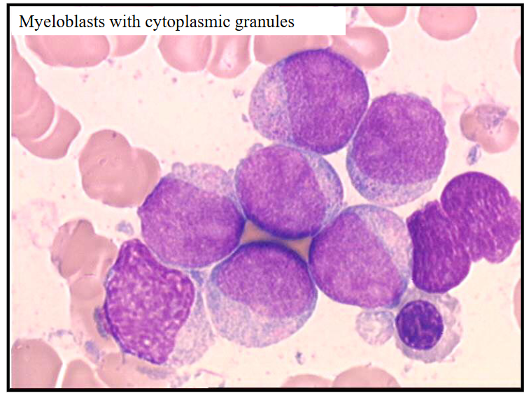 <p>Acute Myeloid Leukaemia - Myeloblasts with Cytoplasmic Granules</p>