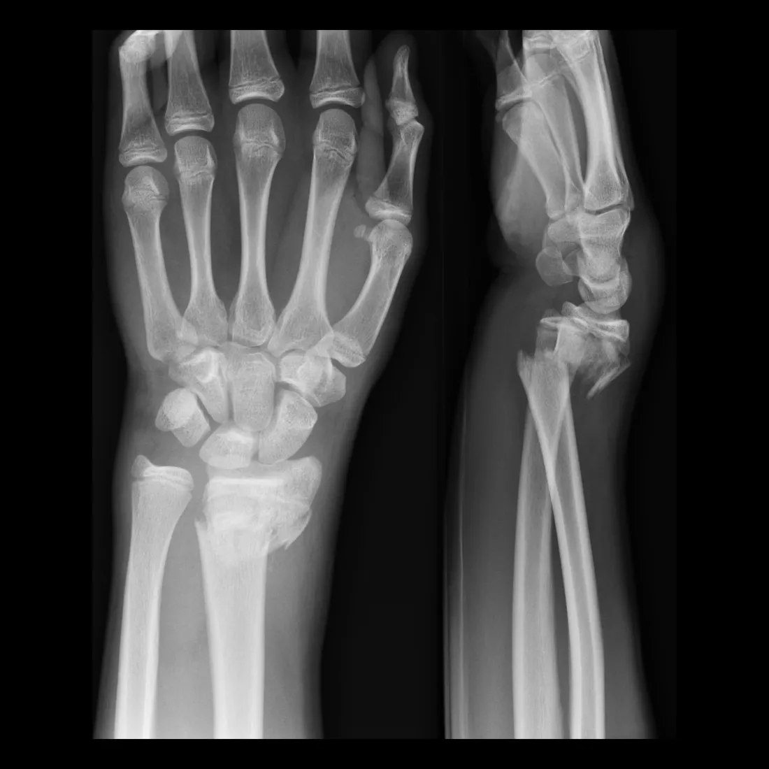 <p><span style="background-color: transparent;">Transverse fracture of the distal radius in which the distal fragment is displaced <u>posteriorly</u>; an associated <strong><em><u>ulnar styloid fracture</u></em></strong> is seen in <strong><em><u>50% to 60%</u></em></strong> of cases</span></p>
