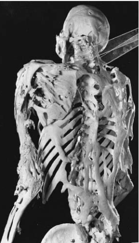 <ol><li><p>Bones that form where they shouldn’t (within soft tissue)</p></li><li><p>Disease or genetic mutation</p></li></ol><p></p>